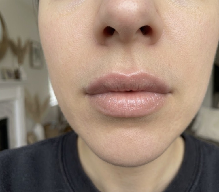 Client photo sent for a filler consultation